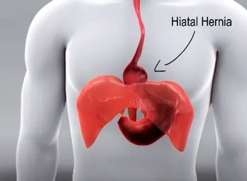Hiatal Hernia consultation at Niraaya Hospital